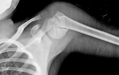 Классификация переломов проксимальной части плечевой кости