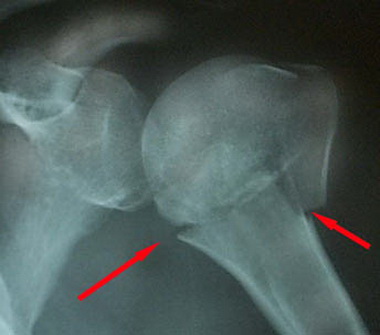 Внешняя фиксация при переломах плечевой кости